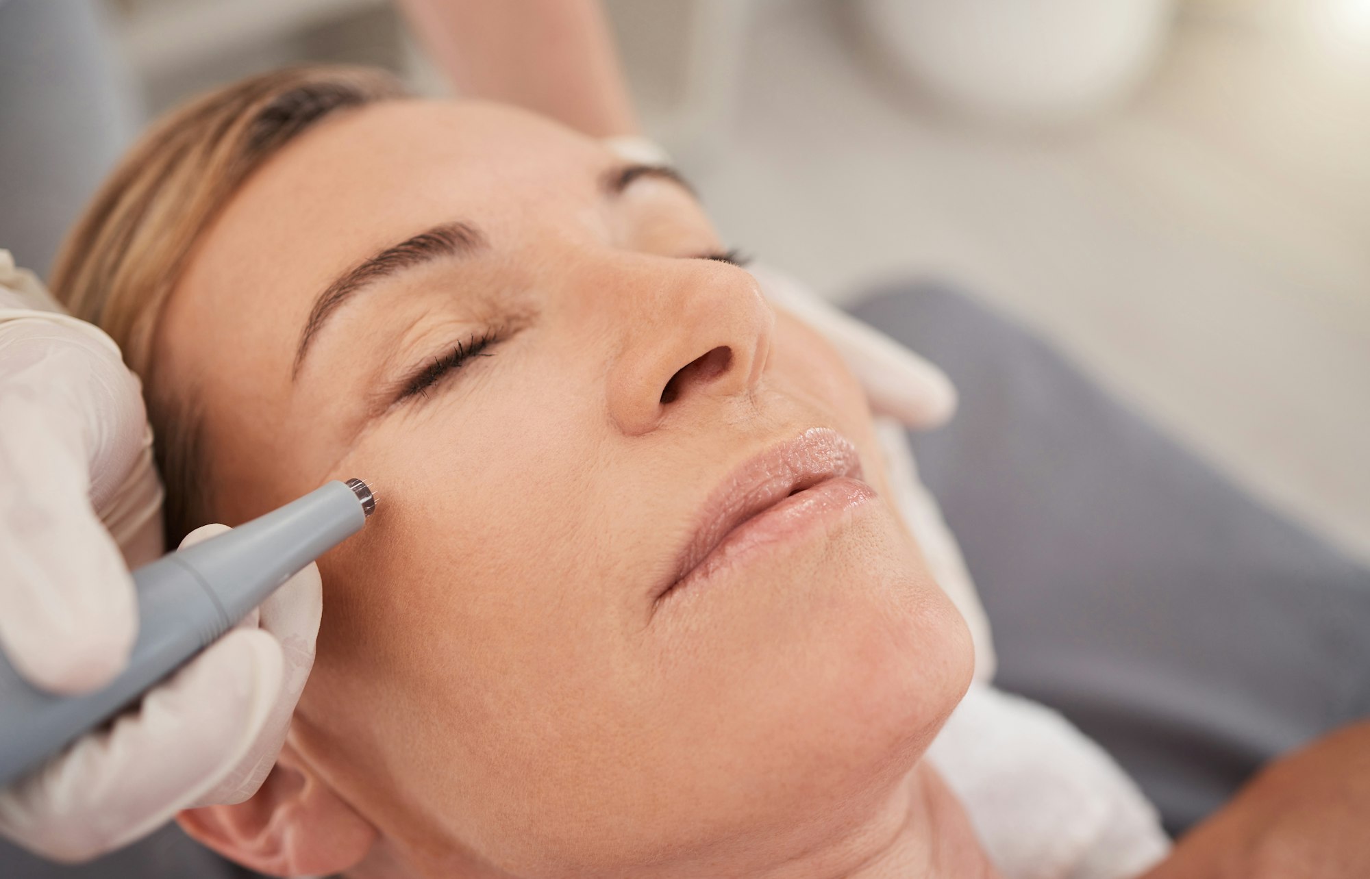 micro-needling-minimises-your-pores